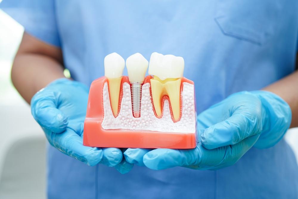 dental implants watertown wi